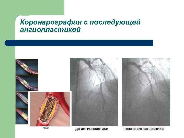 Коронарография с последующей ангиопластикой 