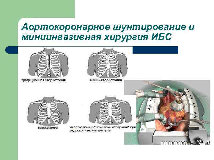 Аортокоронарное шунтирование и миниинвазивная хирургия ИБС 