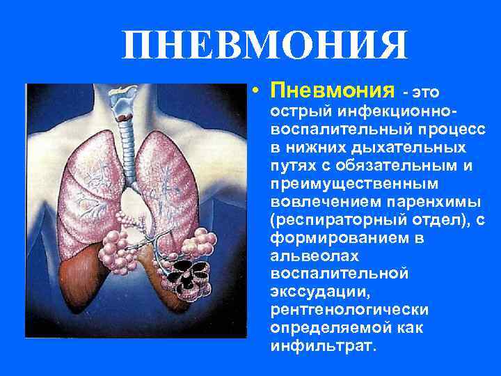 ПНЕВМОНИЯ • Пневмония - это острый инфекционно- воспалительный процесс в нижних дыхательных путях с