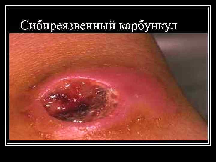 Сибиреязвенный карбункул 