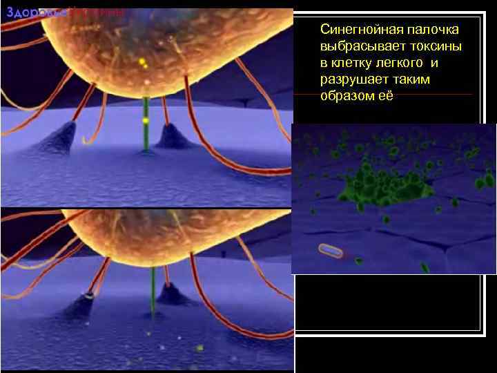 Синегнойная палочка выбрасывает токсины в клетку легкого и разрушает таким образом её 