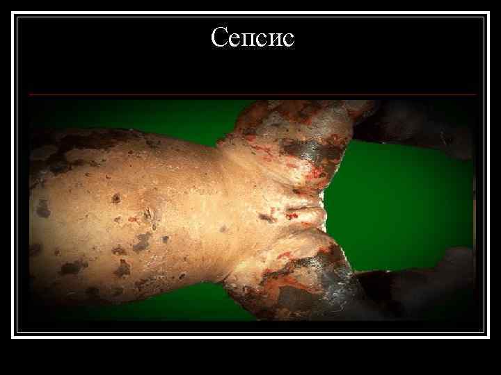 Сепсис 