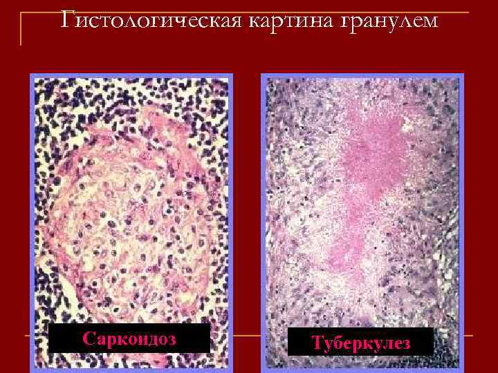 Гистологическая картина гранулем Саркоидоз Туберкулез 