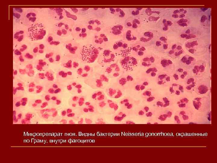 Микропрепарат гноя. Видны бактерии Neisseria gonorrhoea, окрашенные по Граму, внутри фагоцитов 