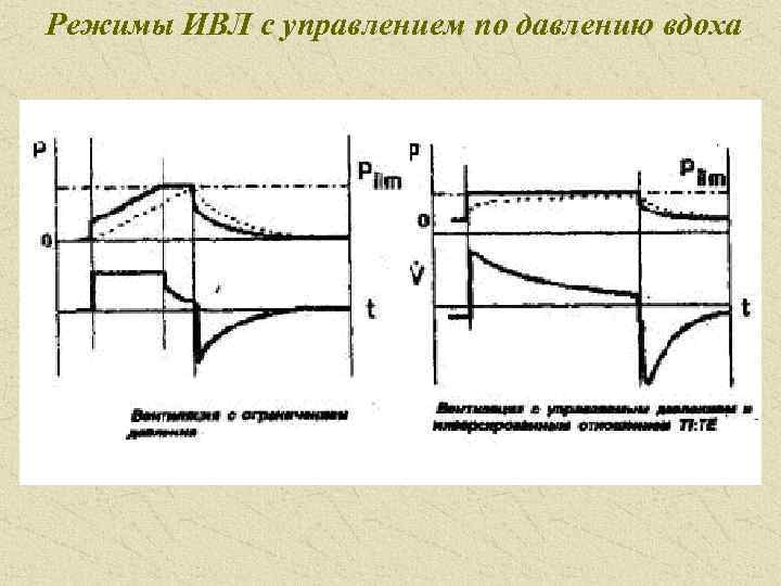 Режимы ИВЛ с управлением по давлению вдоха 