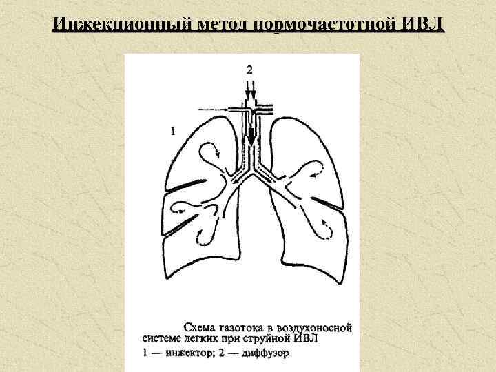 Инжекционный метод нормочастотной ИВЛ 