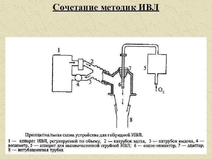 Сочетание методик ИВЛ 
