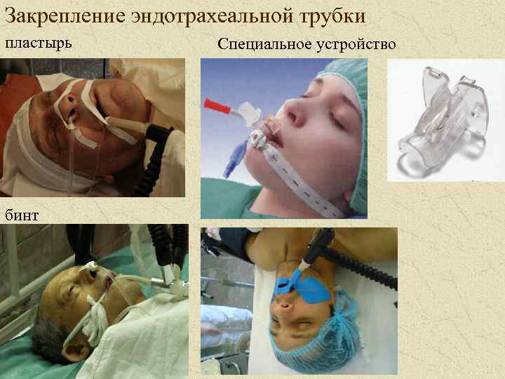 Закрепление эндотрахеальной трубки пластырь бинт Специальное устройство 