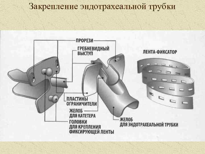 Закрепление эндотрахеальной трубки 