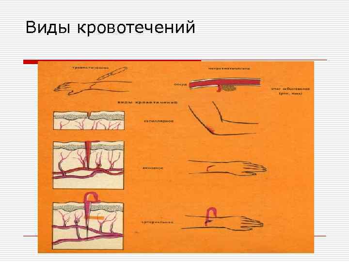 Виды кровотечений 