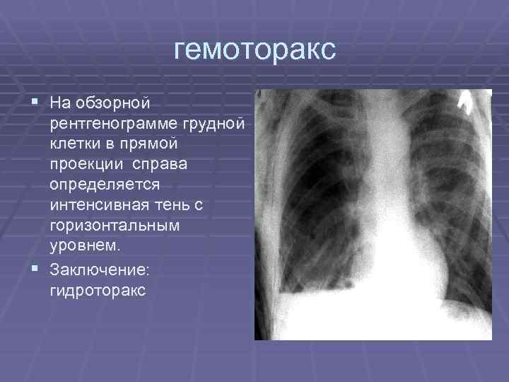 гемоторакс § На обзорной рентгенограмме грудной клетки в прямой проекции справа определяется интенсивная тень