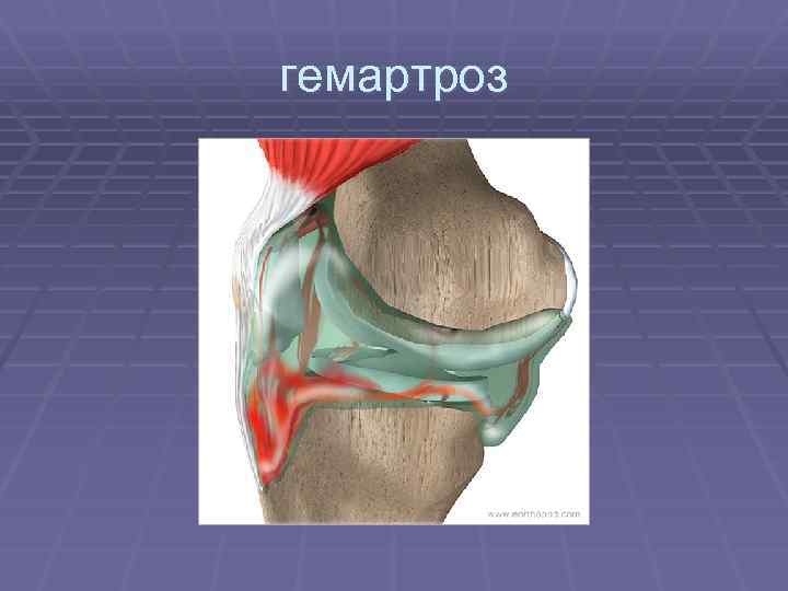 гемартроз 