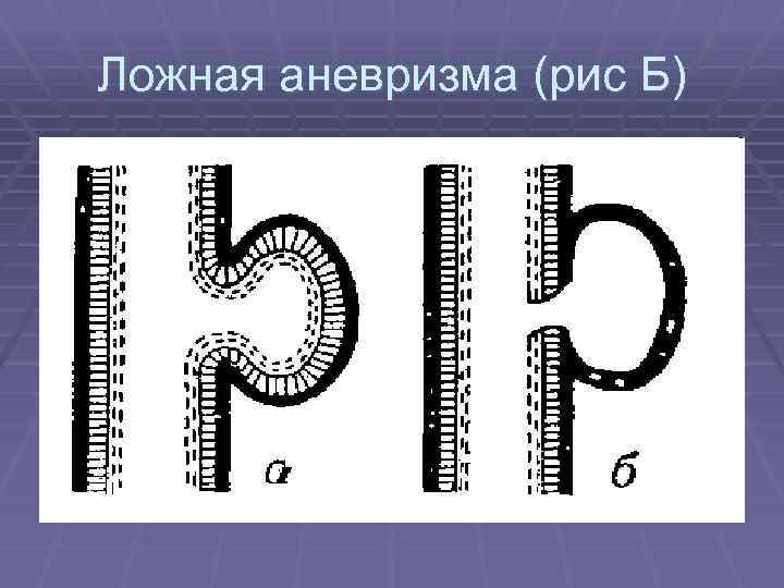 Ложная аневризма (рис Б) 