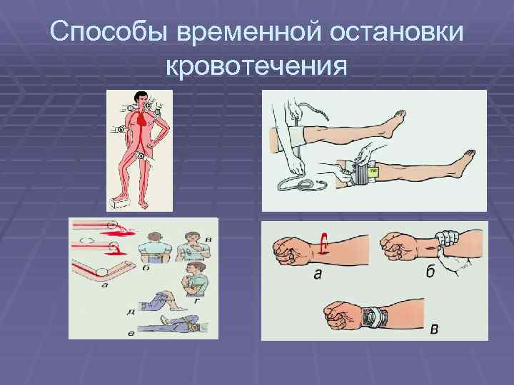 Способы временной остановки кровотечения 