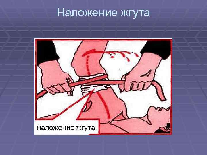 Наложение жгута 