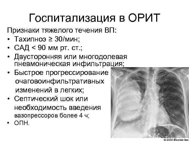 Госпитализация в ОРИТ Признаки тяжелого течения ВП: • Тахипноэ ≥ 30/мин; • САД <