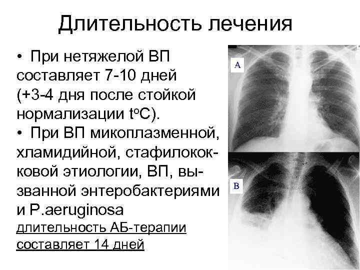 Длительность лечения • При нетяжелой ВП составляет 7 -10 дней (+3 -4 дня после