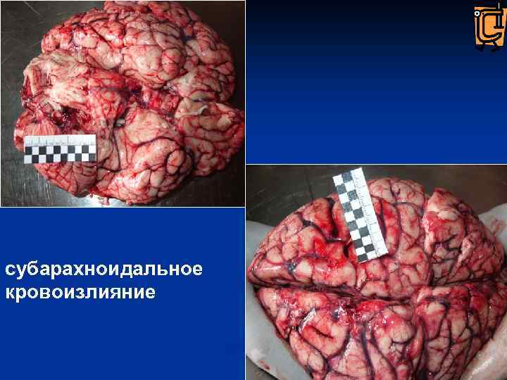 субарахноидальное кровоизлияние 