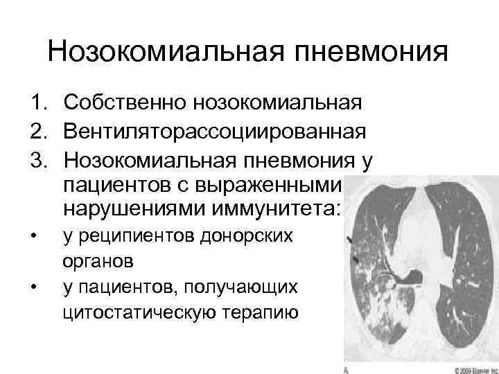 Нозокомиальная пневмония. Критерии нозокомиальной пневмонии. Собственно нозокомиальная пневмония. Нозокомиальная пневмония диагноз. Клиника нозокомиальной пневмонии.