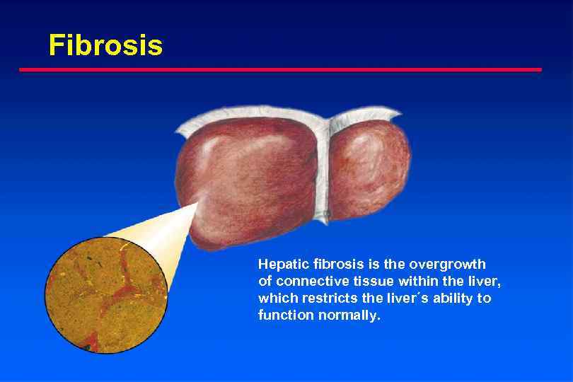 Fibrosis Hepatic fibrosis is the overgrowth of connective tissue within the liver, which restricts