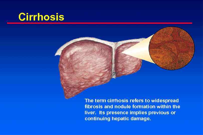 Cirrhosis The term cirrhosis refers to widespread fibrosis and nodule formation within the liver.