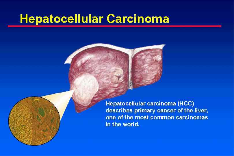 Hepatocellular Carcinoma Hepatocellular carcinoma (HCC) describes primary cancer of the liver, one of the