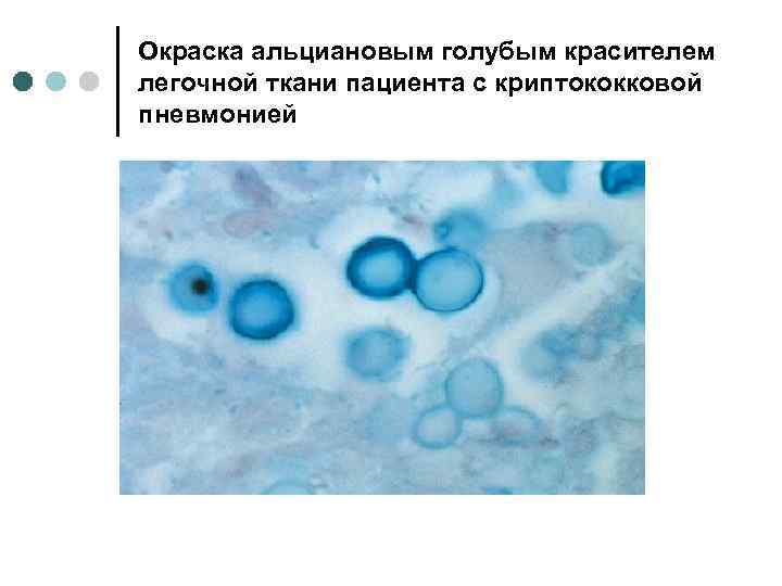 Окраска альциановым голубым красителем легочной ткани пациента с криптококковой пневмонией 
