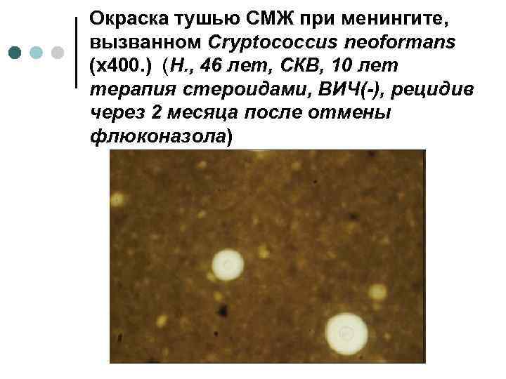 Окраска тушью СМЖ при менингите, вызванном Cryptococcus neoformans (х400. ) (Н. , 46 лет,