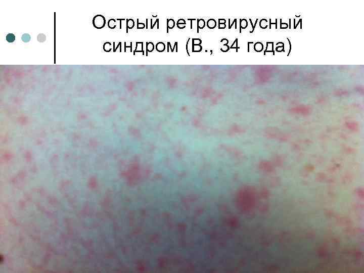 Острый ретровирусный синдром (В. , 34 года) 