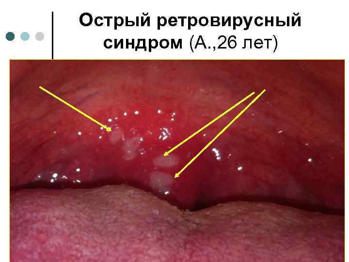 Острый ретровирусный синдром (А. , 26 лет) 