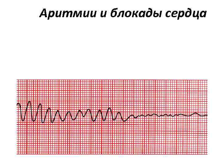 Аритмии и блокады сердца 