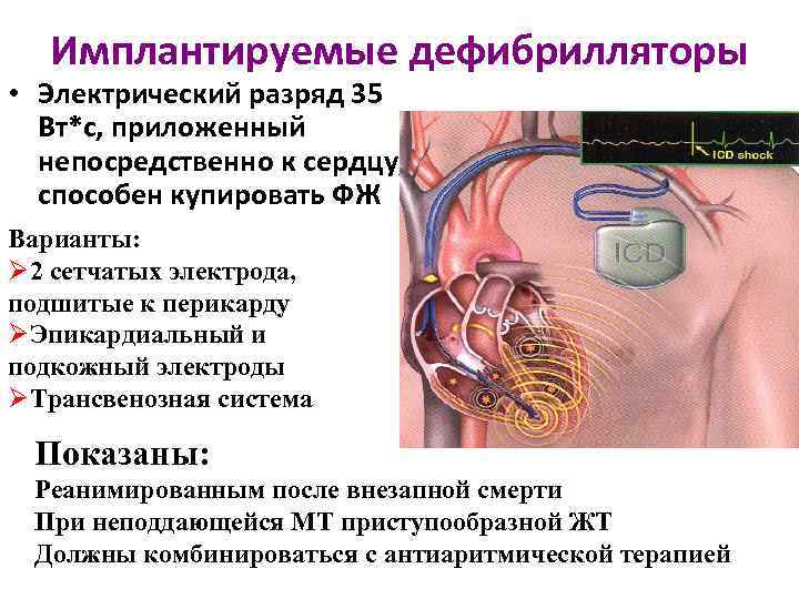Имплантируемые дефибрилляторы • Электрический разряд 35 Вт*с, приложенный непосредственно к сердцу, способен купировать ФЖ