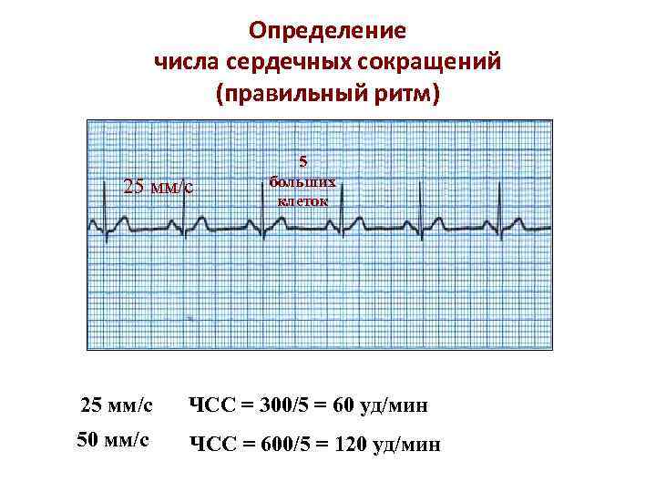 Определение числа сердечных сокращений (правильный ритм) 25 мм/с 5 больших клеток 25 мм/с ЧСС