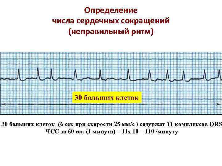 Определение числа сердечных сокращений (неправильный ритм) 30 больших клеток (6 сек при скорости 25