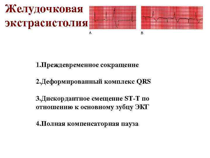 Желудочковая экстрасистолия 1. Преждевременное сокращение 2. Деформированный комплекс QRS 3. Дискордантное смещение ST-T по