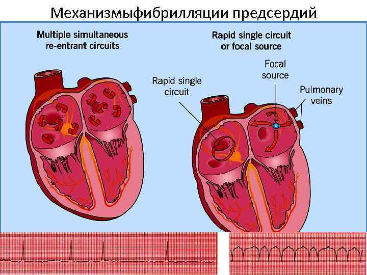 Механизмыфибрилляции предсердий 