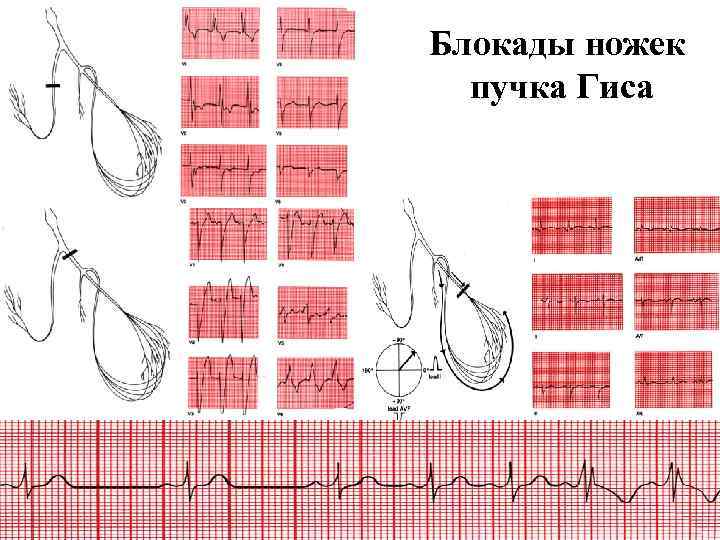 Блокады ножек пучка Гиса 