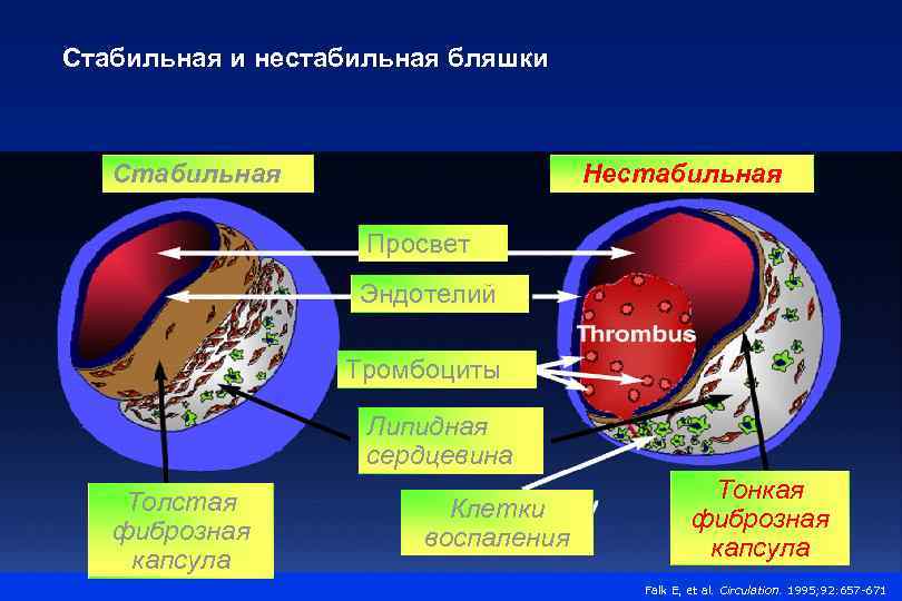 Стабильная и нестабильная бляшки Стабильная Нестабильная Просвет Эндотелий Тромбоциты Липидная сердцевина Толстая фиброзная капсула