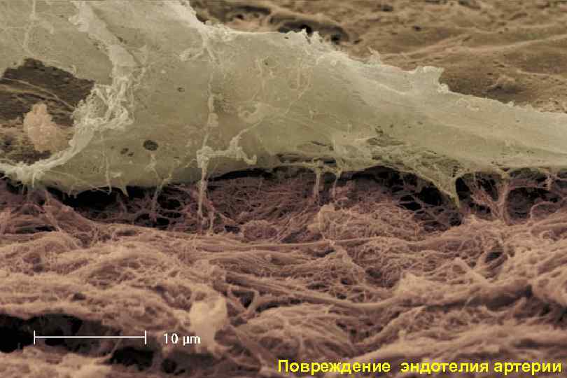 Slide 8 Повреждение эндотелия артерии 