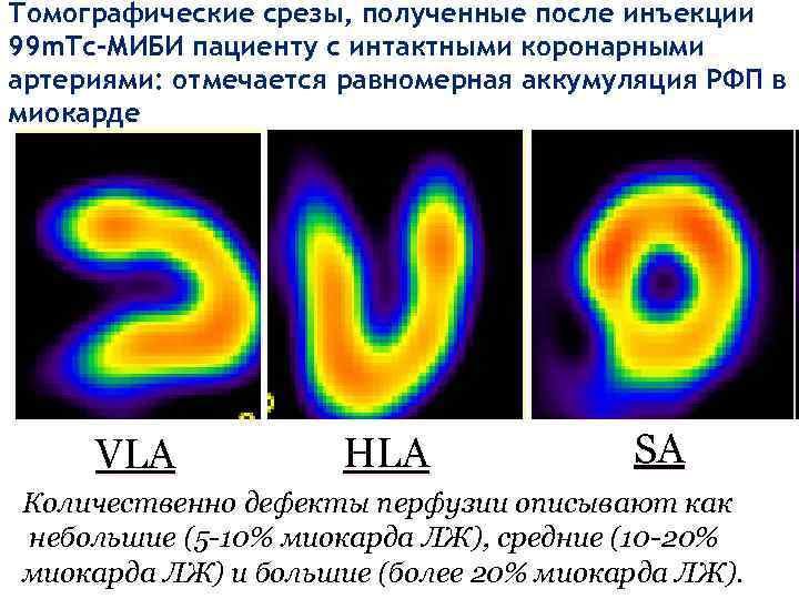 Томографические срезы, полученные после инъекции 99 m. Тс-МИБИ пациенту с интактными коронарными артериями: отмечается