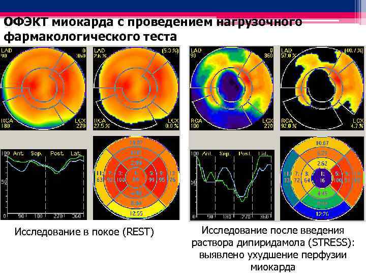 ОФЭКТ миокарда с проведением нагрузочного фармакологического теста Исследование в покое (REST) Исследование после введения