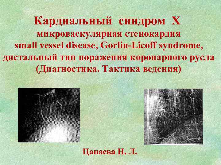 Кардиальный синдром Х микроваскулярная стенокардия small vessel disease, Gorlin-Licoff syndrome, дистальный тип поражения коронарного