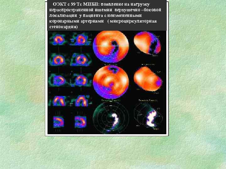 ООЭКТ с 99 Тс МИБИ: появление на нагрузку нераспространенной ишемии верхушечно –боковой локализации у