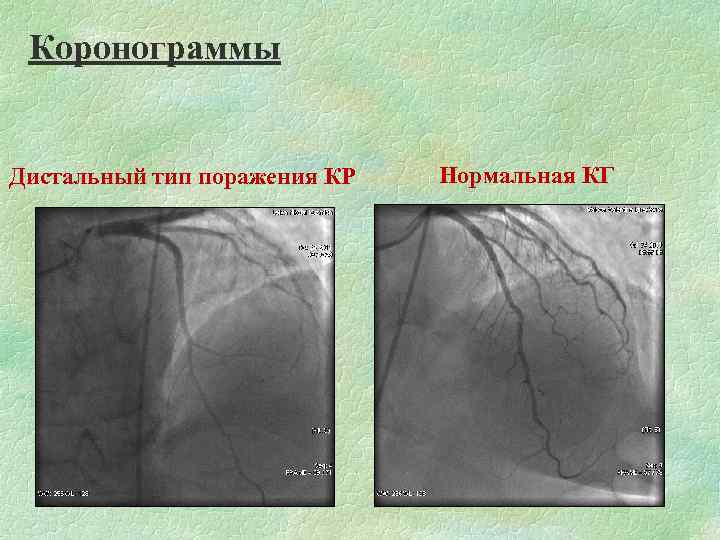 Коронограммы Дистальный тип поражения КР Нормальная КГ 