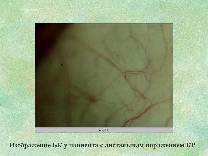 Изображение БК у пациента с дистальным поражением КР 