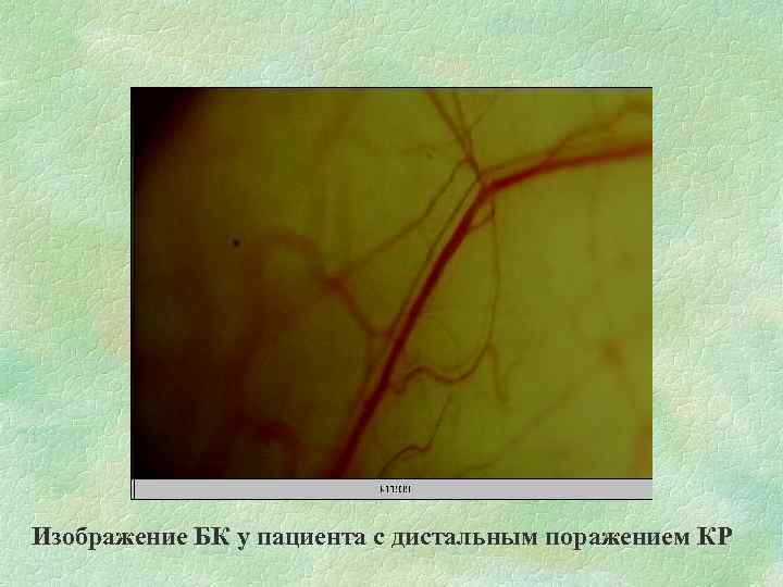 Изображение БК у пациента с дистальным поражением КР 