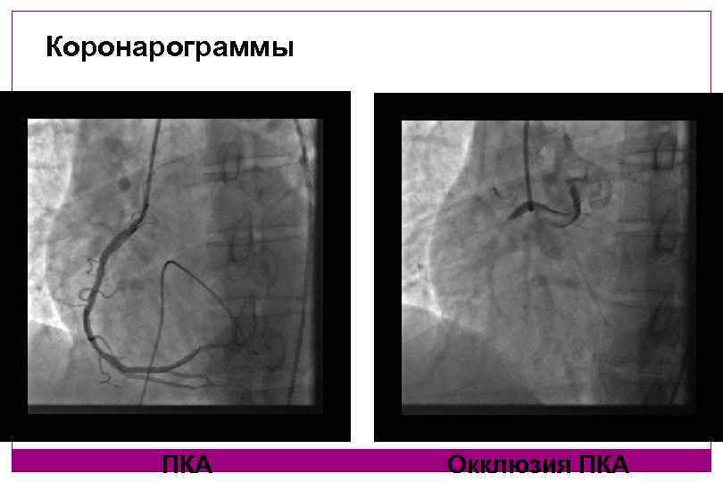 Коронарограммы ПКА Окклюзия ПКА 