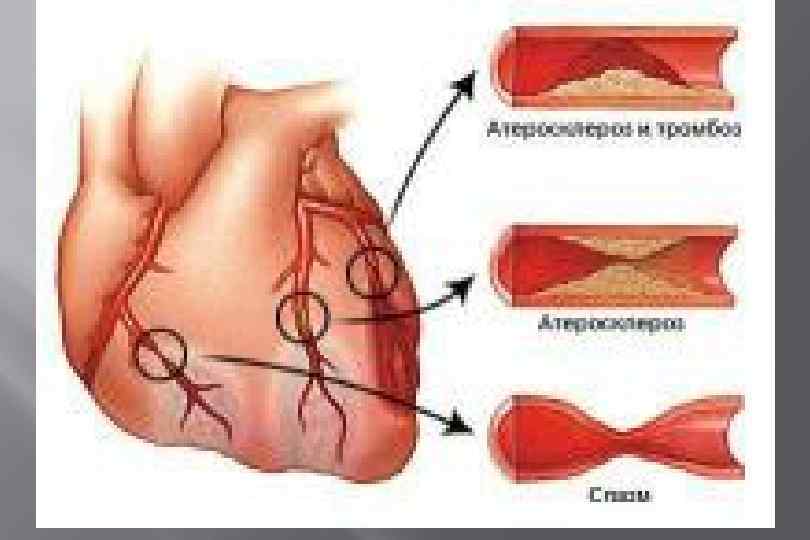 Основные клинические проявления АТЕРОТРОМБОЗА • Транзиторные ишемические атаки • Ишемический инсульт • Стенокардия (СС,