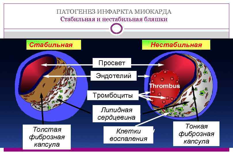 ПАТОГЕНЕЗ ИНФАРКТА МИОКАРДА Стабильная и нестабильная бляшки Стабильная Нестабильная Просвет Эндотелий Тромбоциты Липидная сердцевина
