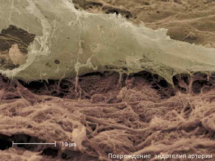 Slide 4 Повреждение эндотелия артерии 